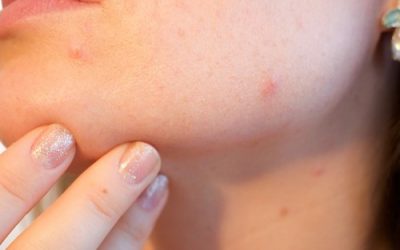 Understanding The Skin Condition Eczema