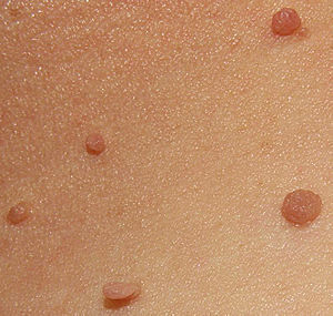 Growths: Skin Tags
