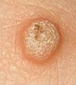 Growths: Common Wart